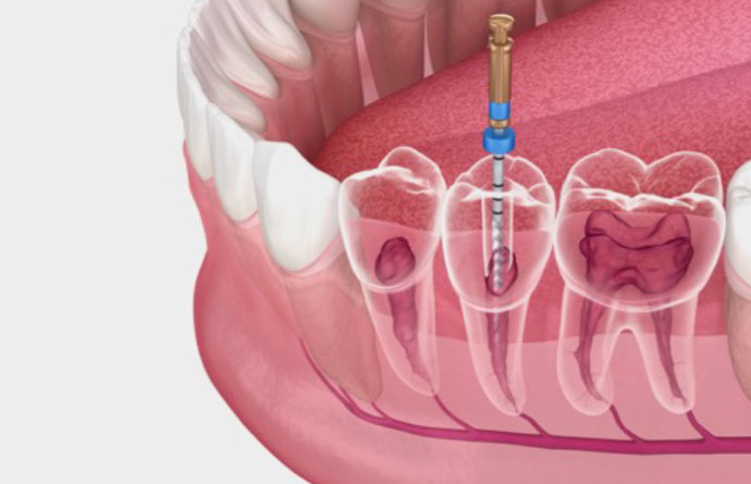 Revisión posterior a endodoncia