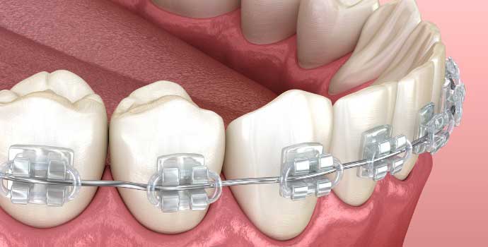 Imagen dientes con brackets